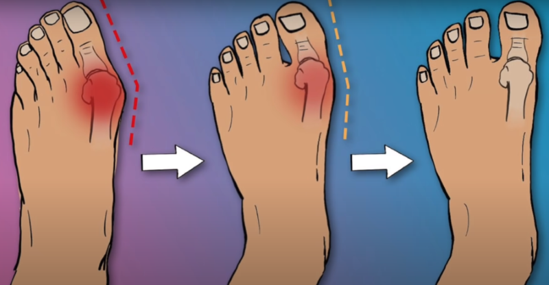gout pain relief cream