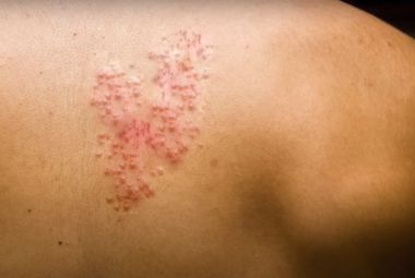 Pain Relief for Shingles