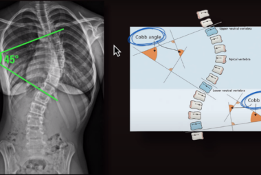 scoliosis pain relief