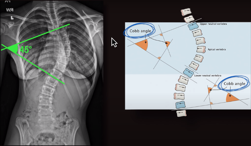 scoliosis pain relief